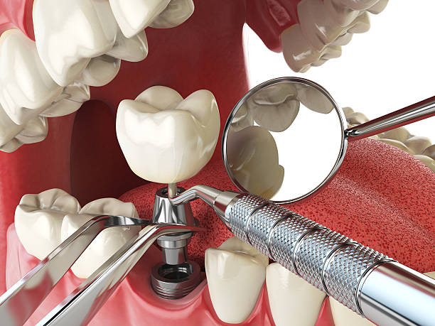 Best Emergency Root Canal Treatment in Bowleys Quarters, MD